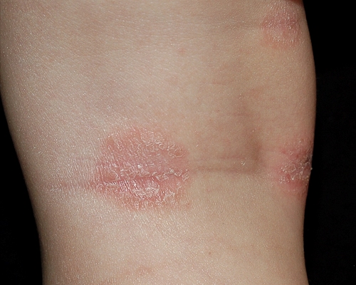 Атопический дерматит вторая стадия