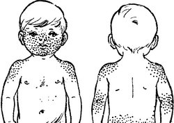 Места высыпаний при кори