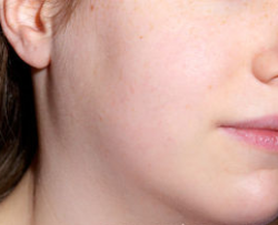 Припухлость слюнных желез при паротите эпидемическом (свинке)