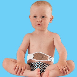 Пупочная грыжа у ребенка