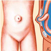 Пупочная грыжа у ребенка