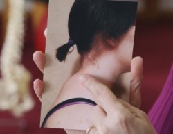 Как убрать вдовий горб (горбик) на шее