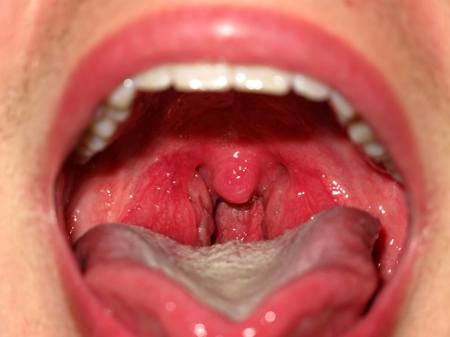 Симптомы аденоидита, воспаленные и увеличенные глоточные миндалины