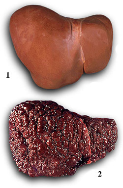 Внешний вид печени при циррозе