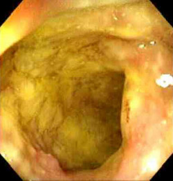 Симптомы и лечение энтероколита