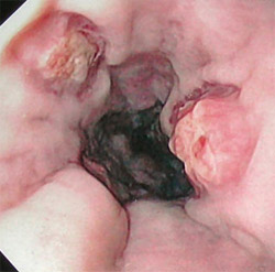 На фото поврежденный пищевод при эзофагите
