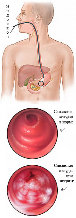 Гастрит с повышенной, пониженной и нормальной кислотностью