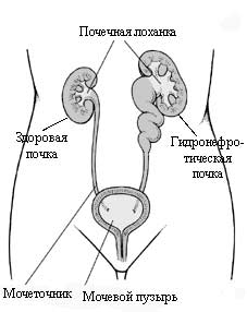 Гидронефроз