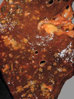 Острый и хронический холангит, экстра-интрапеченочный абсцесс