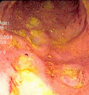 Кишечник, пораженный болезнью крона