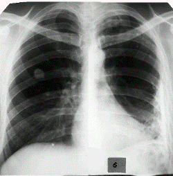 Симптомы и лечение плеврита народными средствами