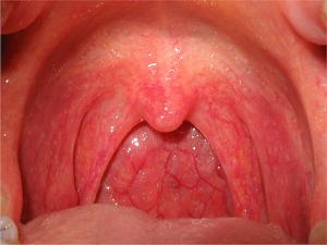 Фото Симптомы острого фарингита