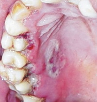 Симптомы язвенно-некротического гингивита
