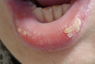 Фото Симптомы хейлита Фото Симптомы хейлита