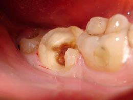 Фото симптомы кариеса