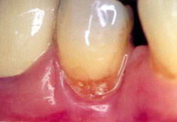 Фото кариес корня
