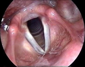 Фото симптомы острого ларингита