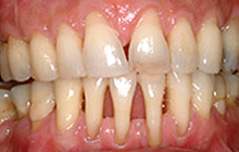Фото симптомы пародонтоза