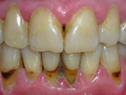 Фото симптомы пародонтоза Фото симптомы пародонтоза