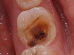 Фото симптомы пульпита