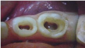 Фото симптомы пульпита