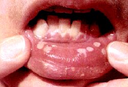Фото симптомы стоматита