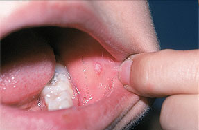 Фото симптомы стоматита Фото симптомы стоматита
