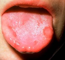 Фото симптомы стоматита Фото симптомы стоматита