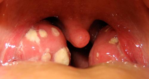 Фото симптомы острого тонзиллита
