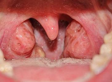 Фото Симптомы хронического тонзиллита