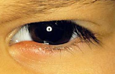 Фото ячмень на глазу