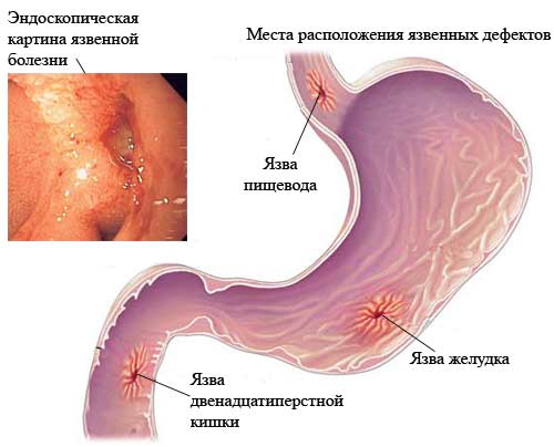 Локализация поражения при язвенной болезни