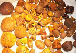 Фото камней в желчном пузыре