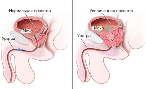 Лечим калькулезный простатит