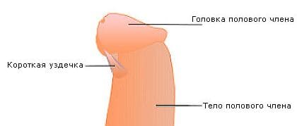 Короткая уздечка полового члена