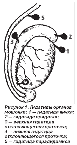 Перекрут гидатиды яичка