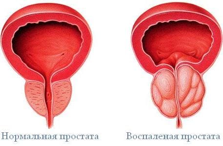 Афала от простатита