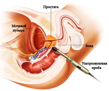 УЗИ простаты