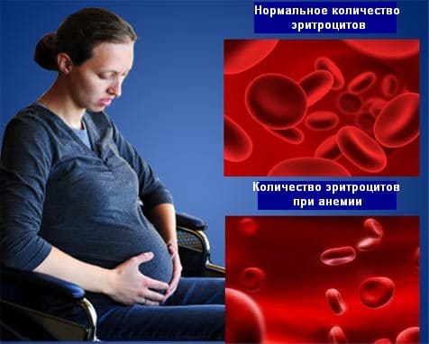 Анемия при беременности - Причины, симптомы и лечение Анемия при беременности - Причины, симптомы и лечение