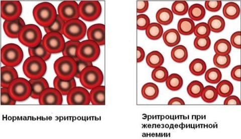 Анемия при беременности - Причины, симптомы и лечение Анемия при беременности - Причины, симптомы и лечение