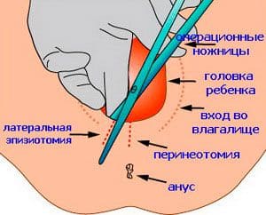 Эпизиотомия и перинеотомия при родах (рассечение промежности)