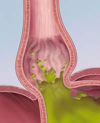 Изжога при беременности - Причины, симптомы и лечение