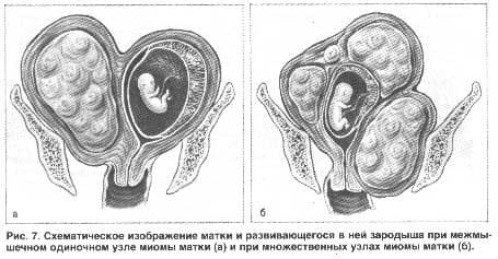 Миома матки при беременности