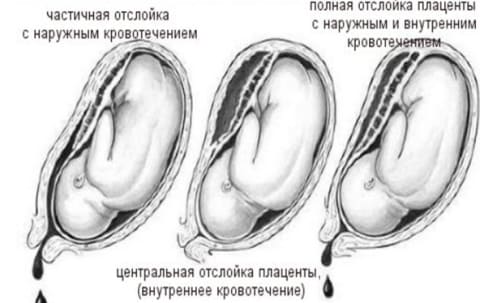 Преждевременная отслойка нормально расположенной плаценты Преждевременная отслойка нормально расположенной плаценты