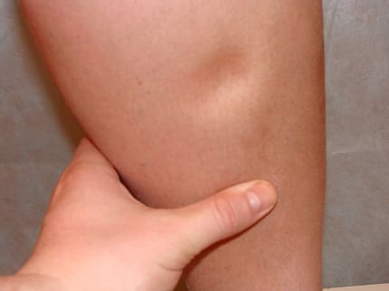 Отеки ног при беременности - Причины, симптомы и лечение Отеки ног при беременности - Причины, симптомы и лечение