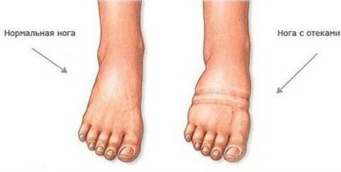 Отеки ног при беременности - Причины, симптомы и лечение Отеки ног при беременности - Причины, симптомы и лечение