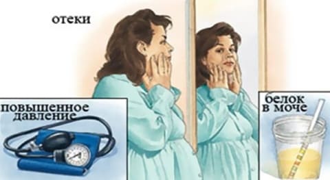 Преэклампсия беременных Преэклампсия беременных