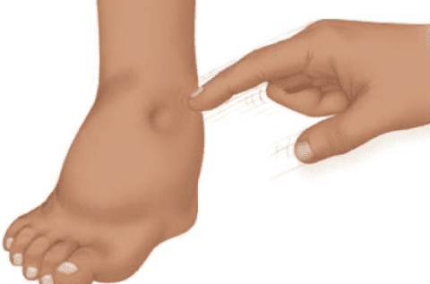 Преэклампсия беременных Преэклампсия беременных