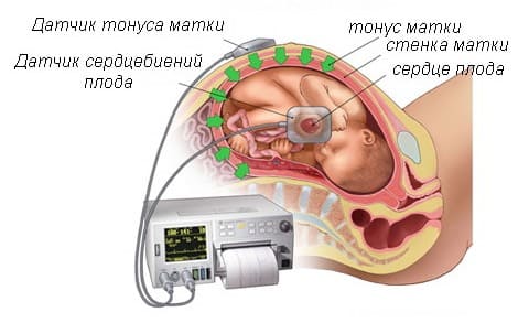 Преэклампсия беременных Преэклампсия беременных