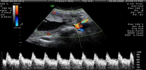 Преэклампсия беременных Преэклампсия беременных